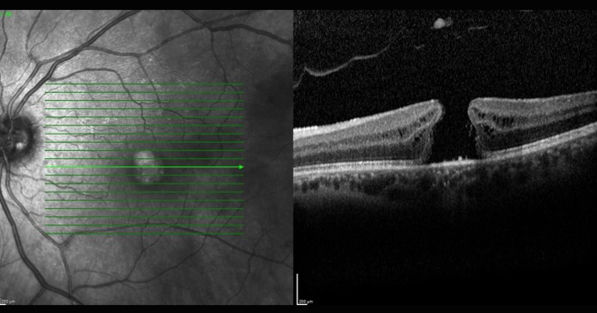 This is an OCT of a 59 year old female who presented with slow deterioration of central vision. This OCT shows a full thickness macula hole.