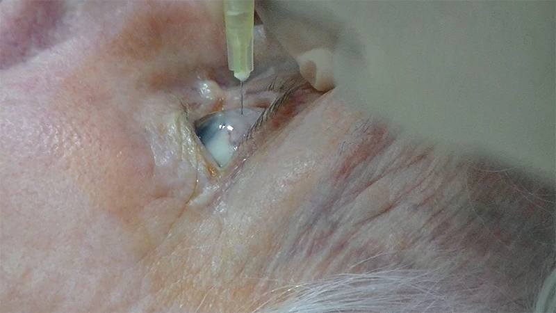 Intravitreal Injections for wet AMD