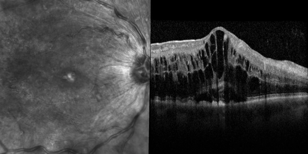 CRVO Treatment - Sydney