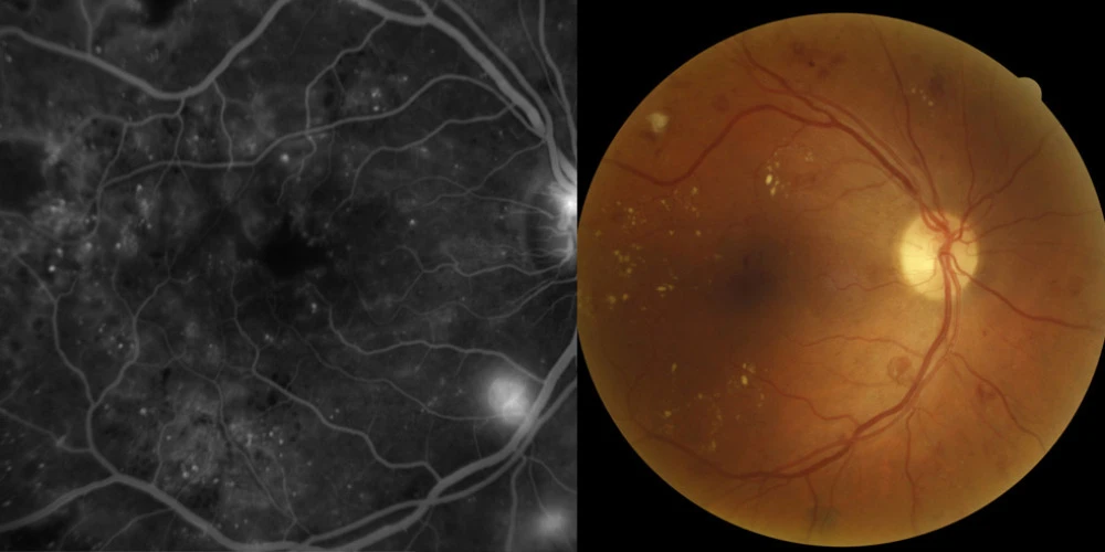 Diabetic Retinopathy Treatment - Sydney