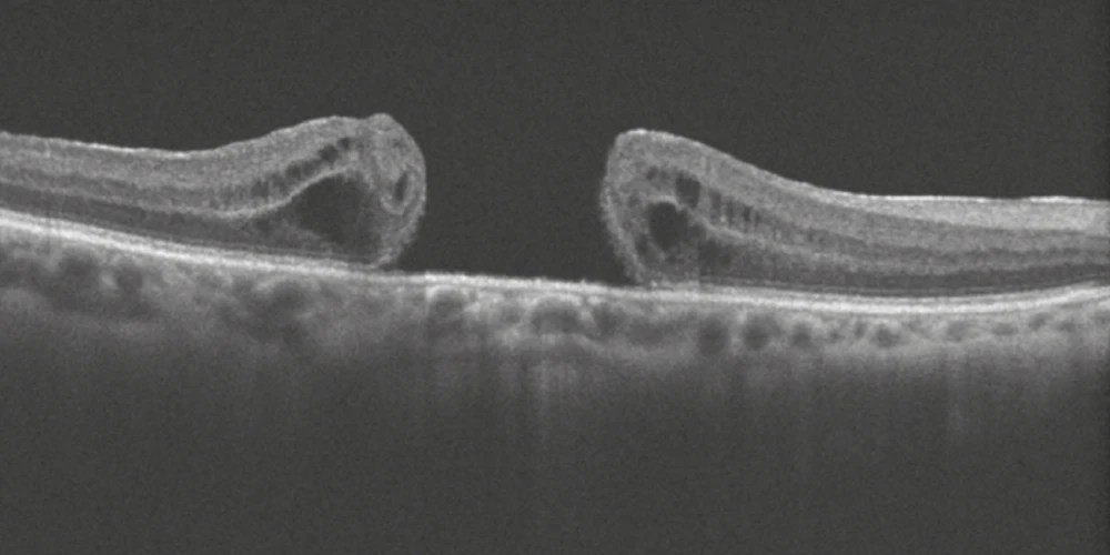 Macular hole treatment - Sydney