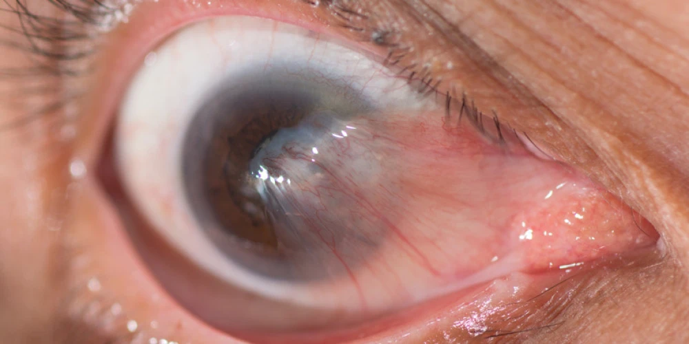 Pterygium treatment - Northbridge