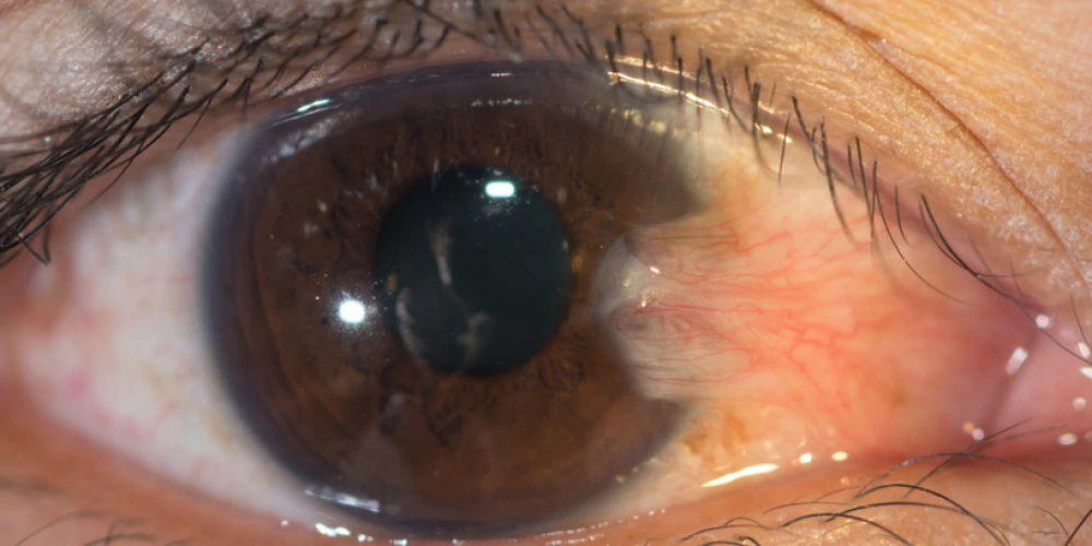 Pterygium treatment - Northbridge