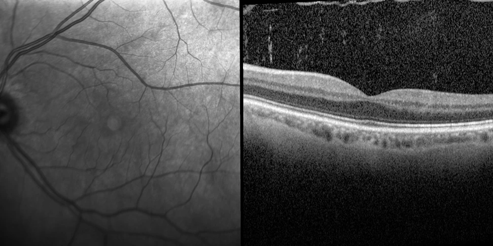 Flashes & floaters treatment - Sydney