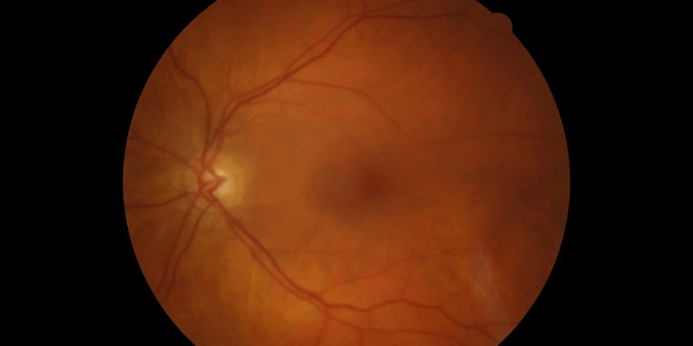 Flashes & floaters treatment - Sydney