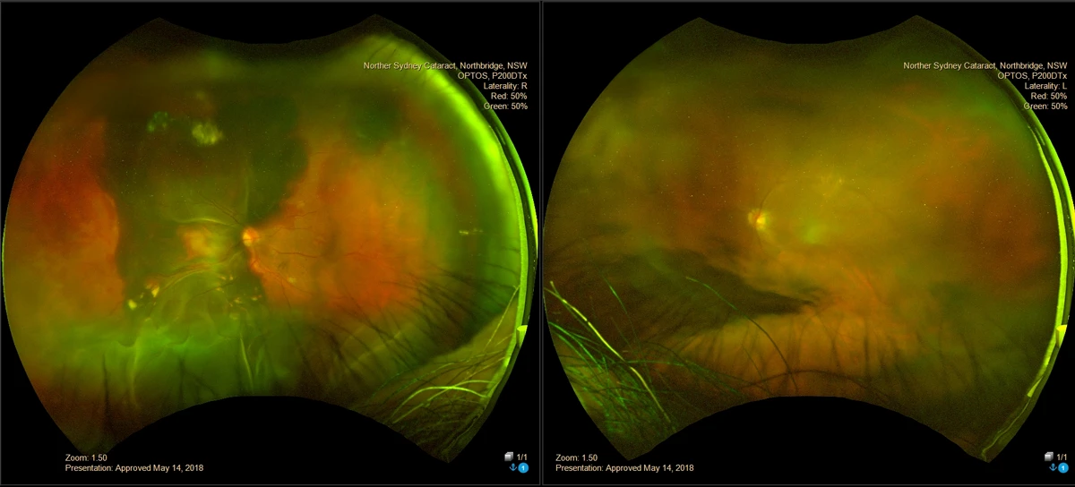 Retinal detachment