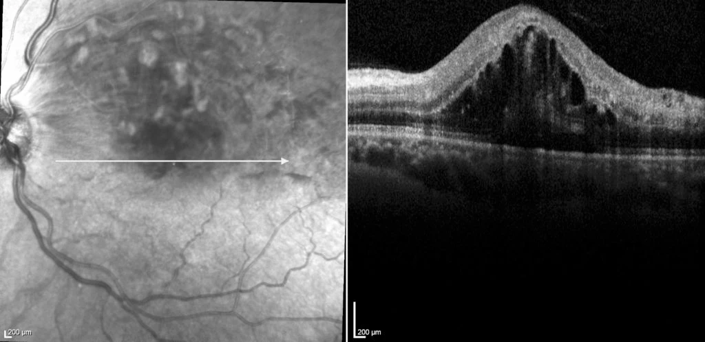 A 40 year old patient presented with sudden onset of painless vision loss from his left eye. There were no associated ocular symptoms and he was systemically well, though moderately over weight.