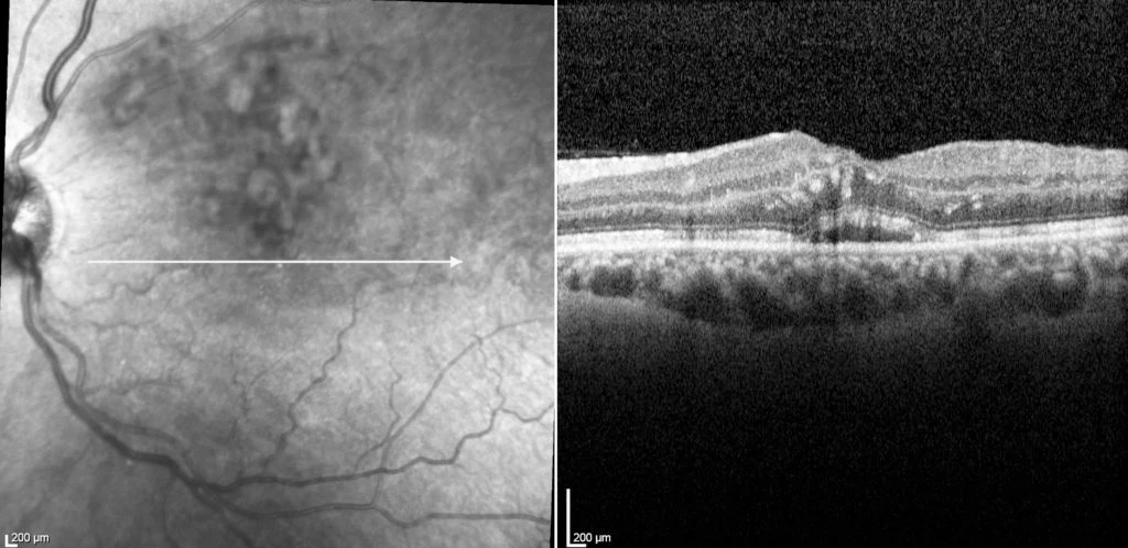 A 40 year old patient presented with sudden onset of painless vision loss from his left eye. There were no associated ocular symptoms and he was systemically well, though moderately over weight.