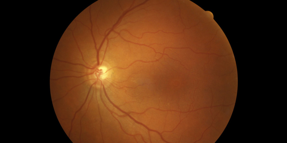 LEFT-MACULA-HOLE-2